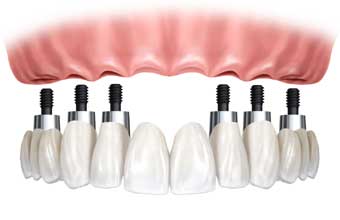 Prótese Dentária Serpa - Foto 1